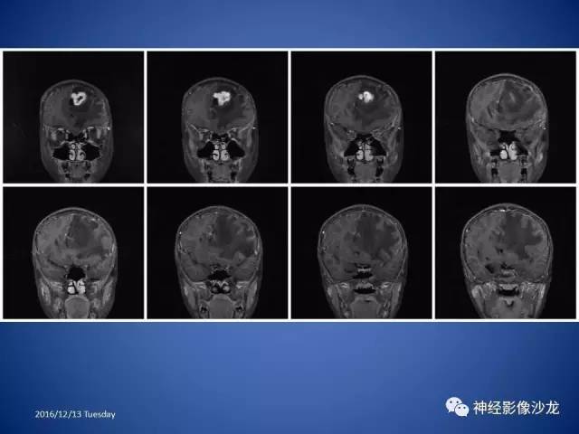 【病例】不典型脑膜瘤1例CT及MR影像讨论 【病例】不典型脑膜瘤1例CT及MR影像讨论