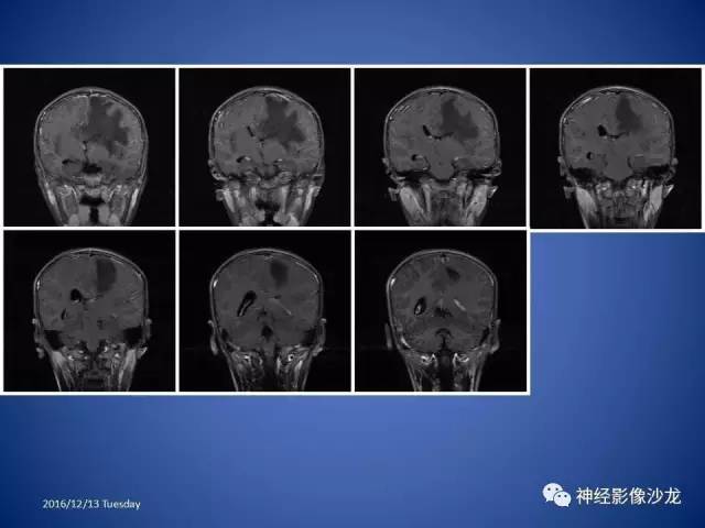 【病例】不典型脑膜瘤1例CT及MR影像讨论 【病例】不典型脑膜瘤1例CT及MR影像讨论
