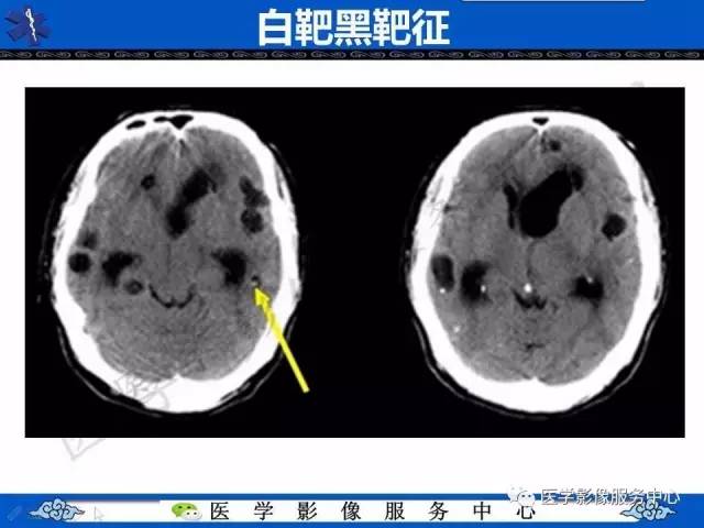 【影像征象】白靶黑靶征