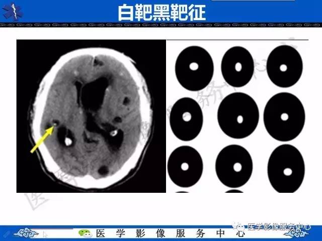 【影像征象】白靶黑靶征