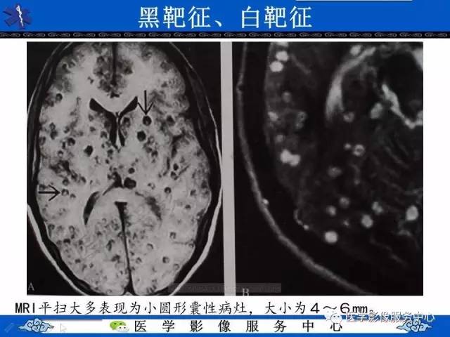 【影像征象】白靶黑靶征