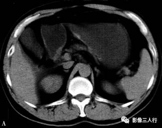 “异位胰腺”的影像诊断 “异位胰腺”的影像诊断
