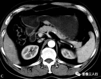 “异位胰腺”的影像诊断 “异位胰腺”的影像诊断