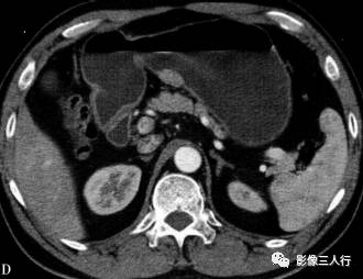 “异位胰腺”的影像诊断 “异位胰腺”的影像诊断