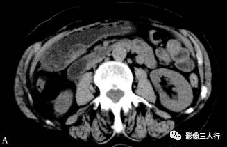 “异位胰腺”的影像诊断 “异位胰腺”的影像诊断