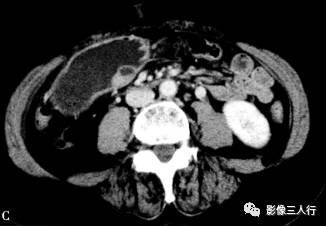 “异位胰腺”的影像诊断 “异位胰腺”的影像诊断