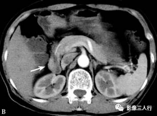 “异位胰腺”的影像诊断 “异位胰腺”的影像诊断