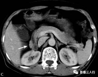 “异位胰腺”的影像诊断 “异位胰腺”的影像诊断