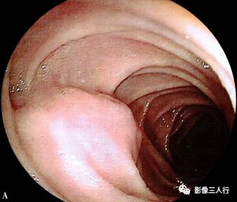 “异位胰腺”的影像诊断 “异位胰腺”的影像诊断