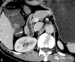 “异位胰腺”的影像诊断 “异位胰腺”的影像诊断