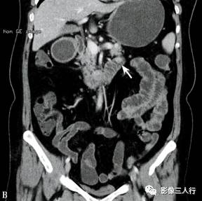 “异位胰腺”的影像诊断 “异位胰腺”的影像诊断