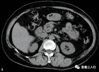 “异位胰腺”的影像诊断 “异位胰腺”的影像诊断