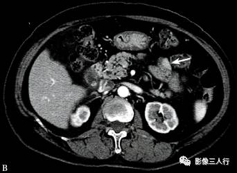 “异位胰腺”的影像诊断 “异位胰腺”的影像诊断