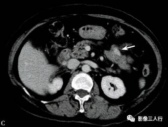 “异位胰腺”的影像诊断 “异位胰腺”的影像诊断