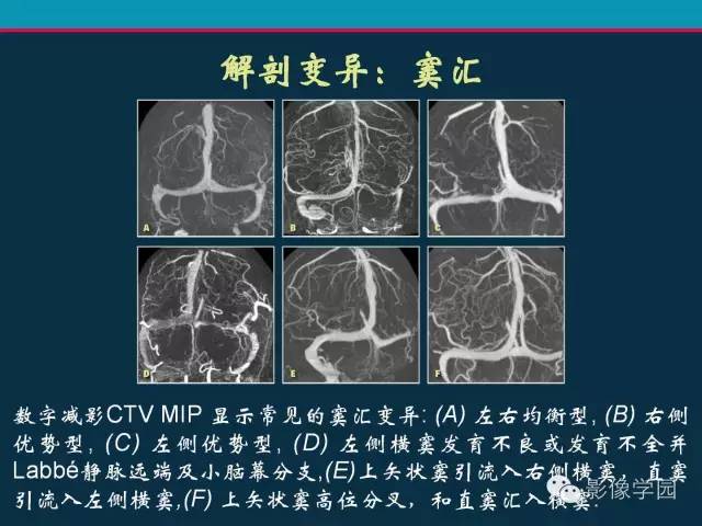 【PPT】颅脑静脉系统CT血管造影：解剖、病理及陷阱