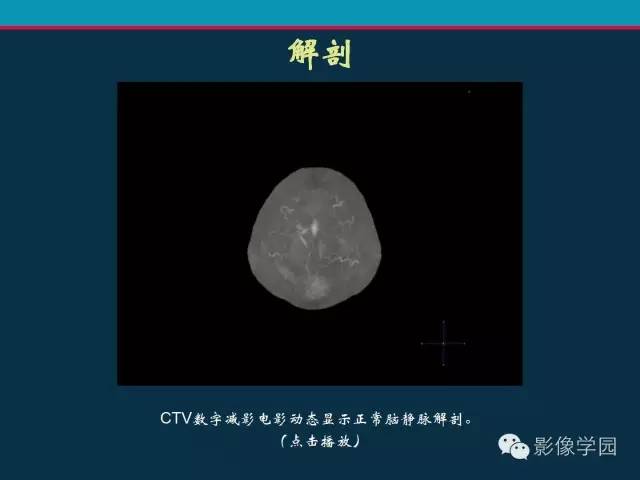 【PPT】颅脑静脉系统CT血管造影：解剖、病理及陷阱