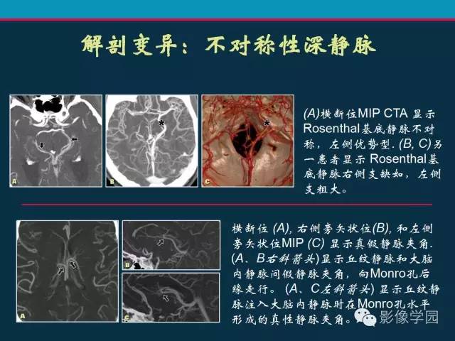 【PPT】颅脑静脉系统CT血管造影：解剖、病理及陷阱