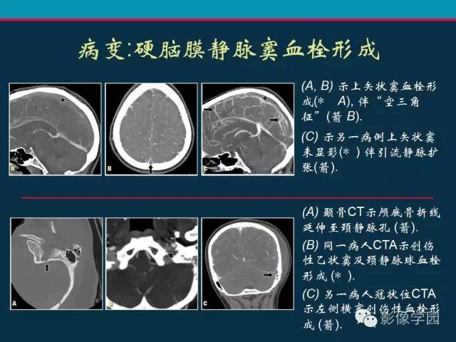 【PPT】颅脑静脉系统CT血管造影：解剖、病理及陷阱