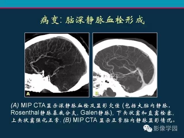 【PPT】颅脑静脉系统CT血管造影：解剖、病理及陷阱