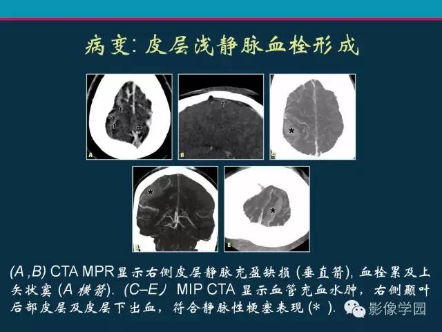 【PPT】颅脑静脉系统CT血管造影：解剖、病理及陷阱
