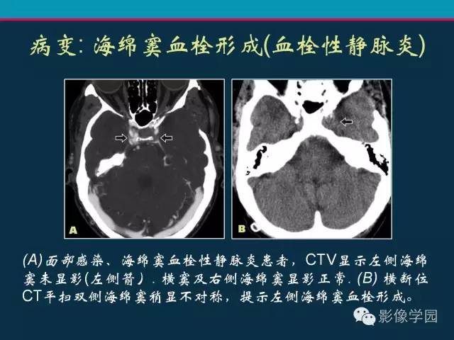 【PPT】颅脑静脉系统CT血管造影：解剖、病理及陷阱
