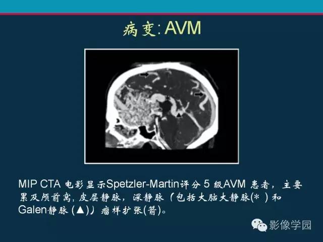 【PPT】颅脑静脉系统CT血管造影：解剖、病理及陷阱