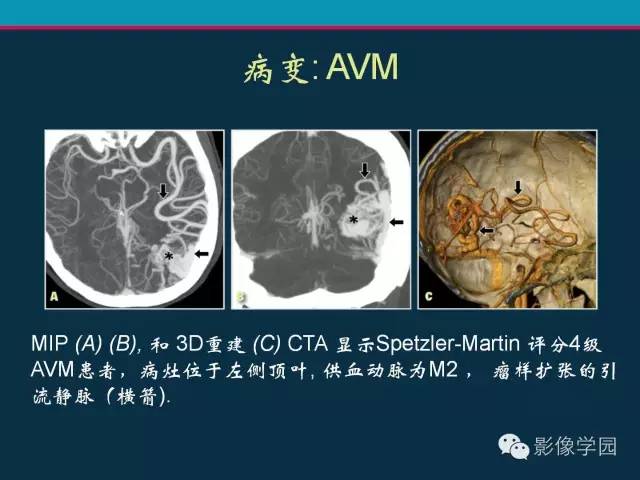 【PPT】颅脑静脉系统CT血管造影：解剖、病理及陷阱