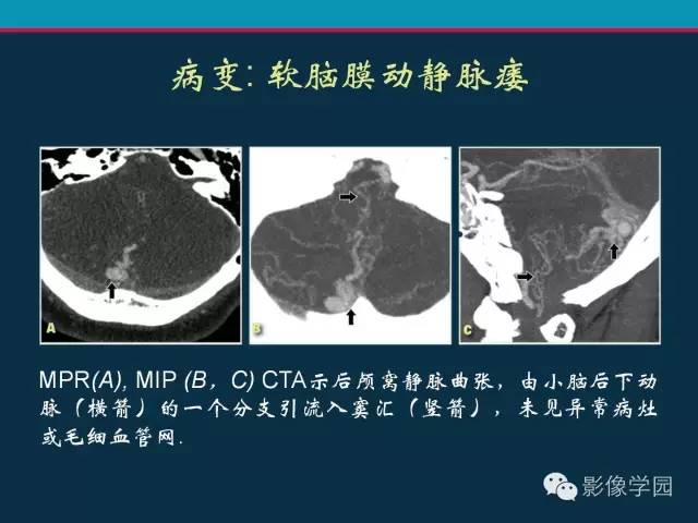【PPT】颅脑静脉系统CT血管造影：解剖、病理及陷阱