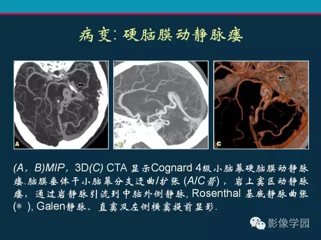 【PPT】颅脑静脉系统CT血管造影：解剖、病理及陷阱