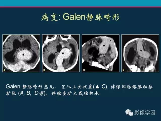 【PPT】颅脑静脉系统CT血管造影：解剖、病理及陷阱