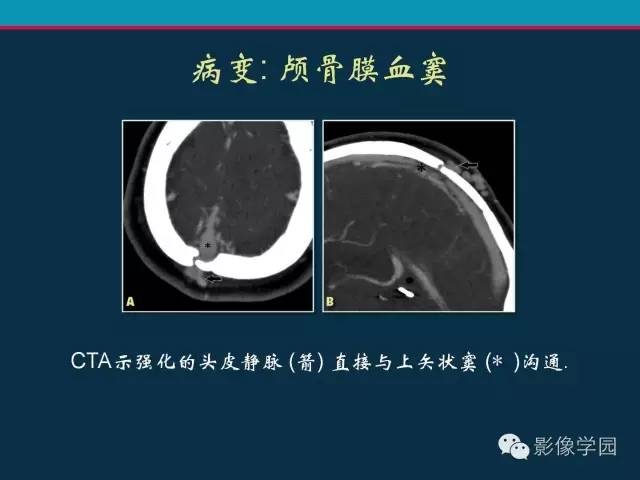 【PPT】颅脑静脉系统CT血管造影：解剖、病理及陷阱