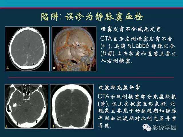 【PPT】颅脑静脉系统CT血管造影：解剖、病理及陷阱