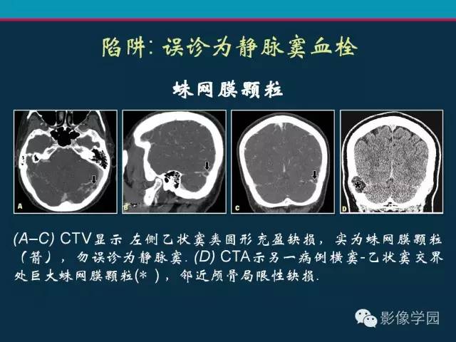 【PPT】颅脑静脉系统CT血管造影：解剖、病理及陷阱