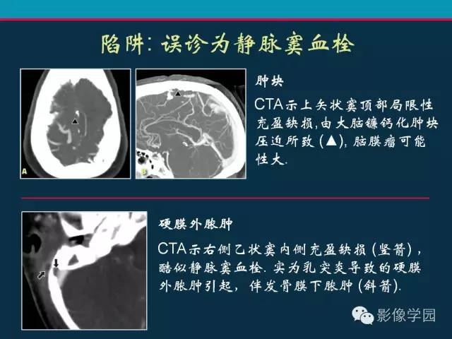 【PPT】颅脑静脉系统CT血管造影：解剖、病理及陷阱