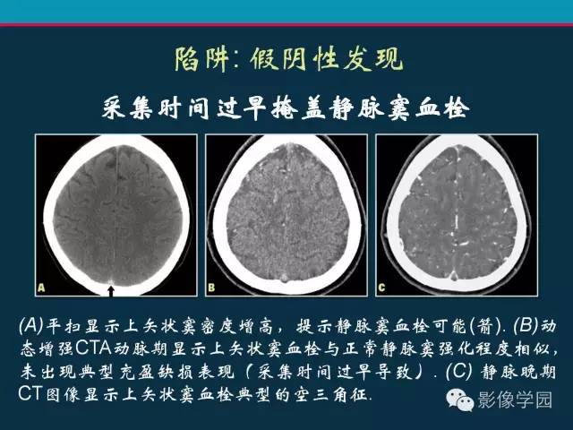 【PPT】颅脑静脉系统CT血管造影：解剖、病理及陷阱