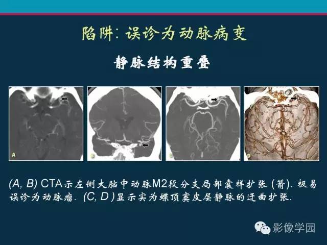 【PPT】颅脑静脉系统CT血管造影：解剖、病理及陷阱