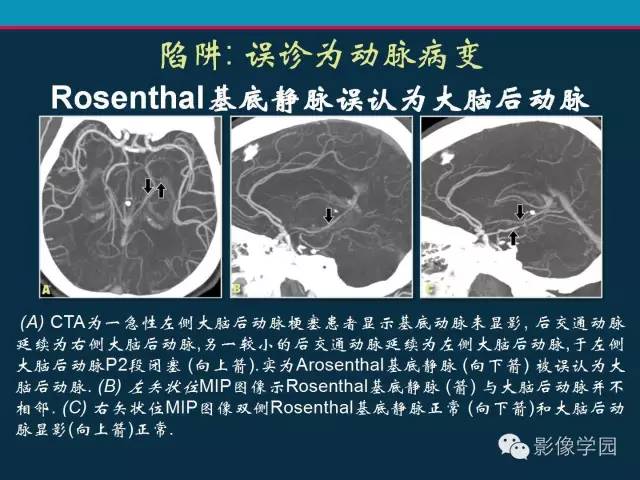 【PPT】颅脑静脉系统CT血管造影：解剖、病理及陷阱