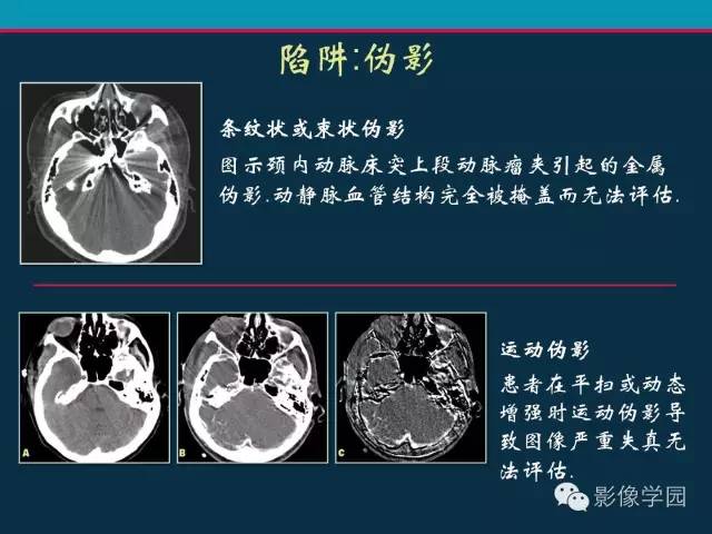 【PPT】颅脑静脉系统CT血管造影：解剖、病理及陷阱