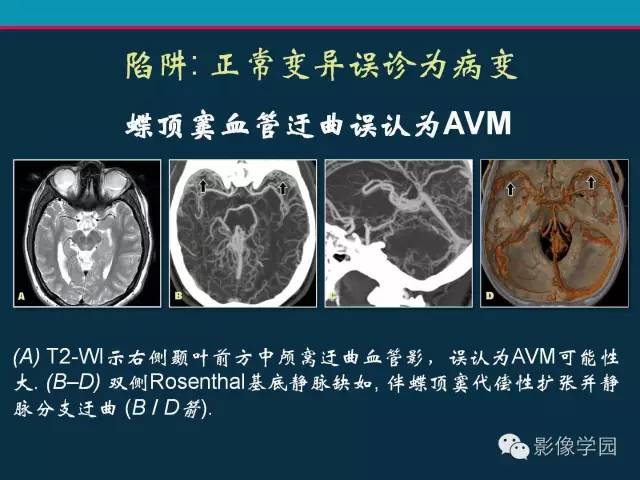 【PPT】颅脑静脉系统CT血管造影：解剖、病理及陷阱