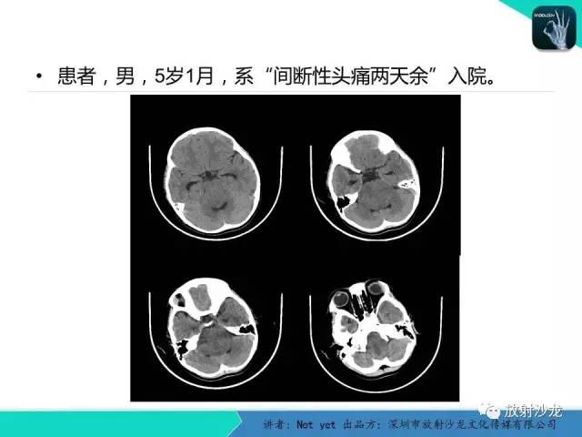 【病例】脑干胶质瘤1例MR影像表现