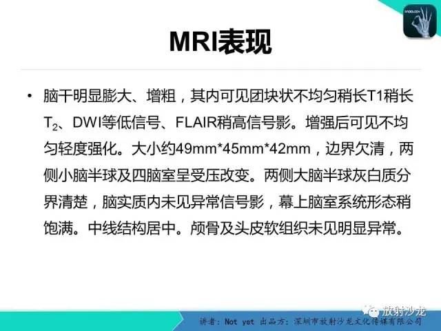 【病例】脑干胶质瘤1例MR影像表现