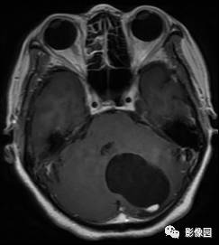 【病例】小脑血管母细胞瘤1例MR影像表现