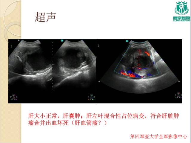 【病例】肝包虫病1例CT影像表现