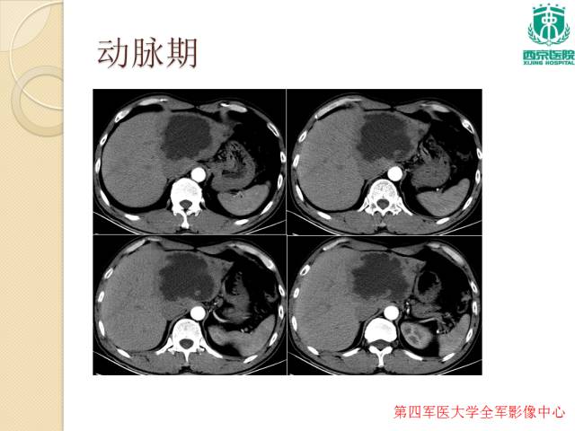 【病例】肝包虫病1例CT影像表现
