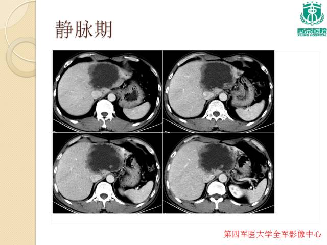 【病例】肝包虫病1例CT影像表现