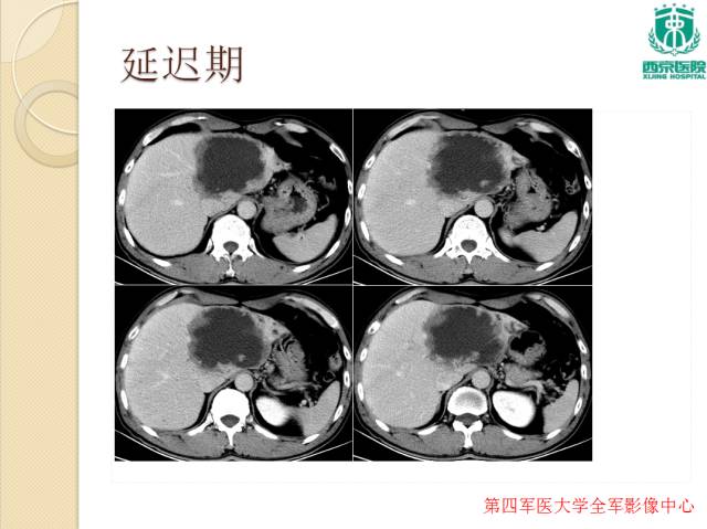【病例】肝包虫病1例CT影像表现
