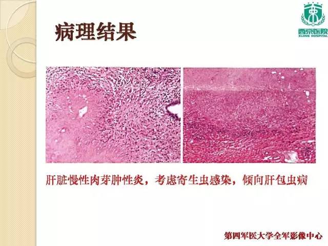 【病例】肝包虫病1例CT影像表现