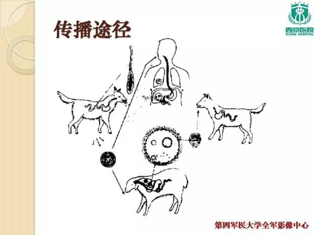 【病例】肝包虫病1例CT影像表现