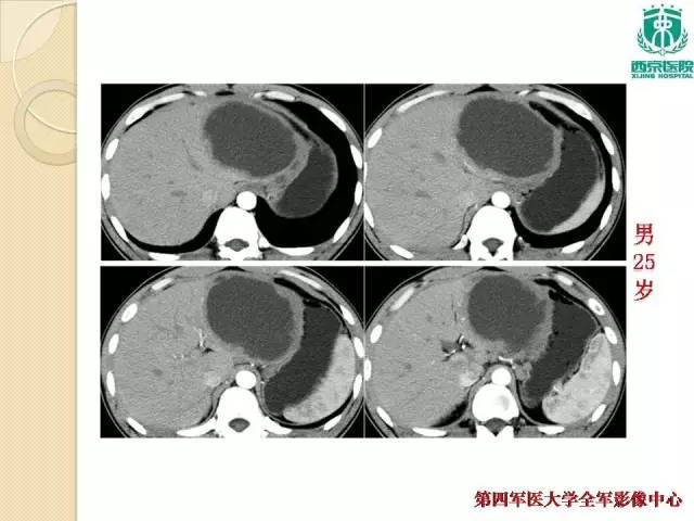 【病例】肝包虫病1例CT影像表现