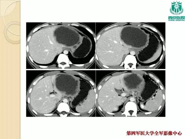 【病例】肝包虫病1例CT影像表现